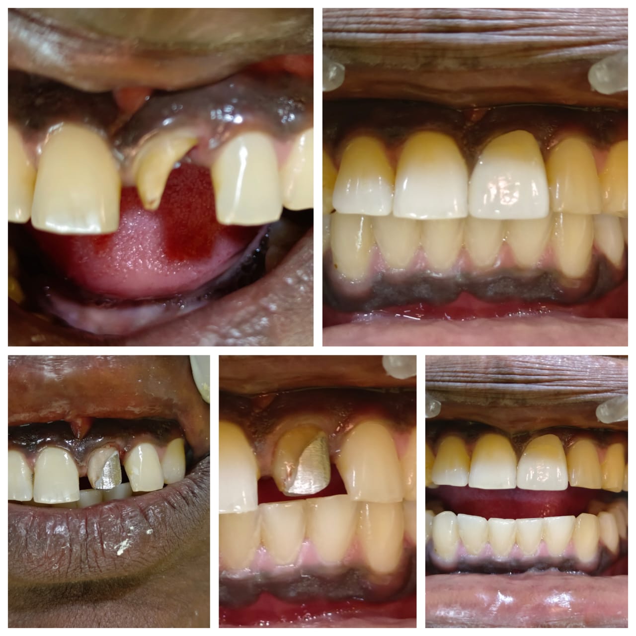 Before & After - Dental Treatment